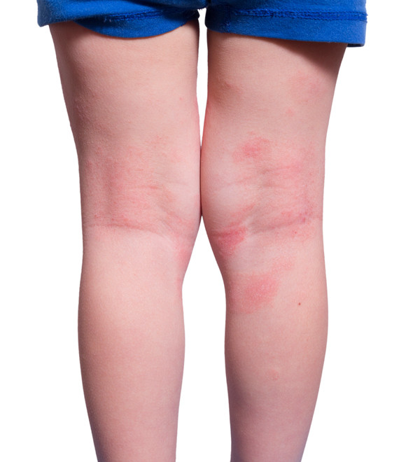 特应性皮炎的特点是皮肤干燥症及瘙痒症,是皮肤炎症反复出现的慢性